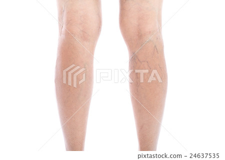 Varicose vein Isolated on white Varicose vein Isolated on white 24637535