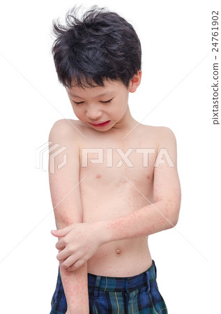 Young boy screatching his arm with rash over white 24761902