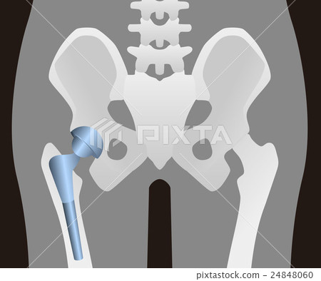 人工髖關節 插圖素材 圖庫