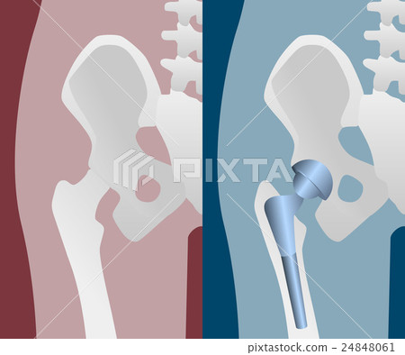 Artificial hip joint before for after Artificial hip joint before for after 24848061