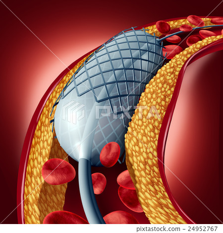 Angioplasty And Stent Concept Angioplasty And Stent Concept 24952767