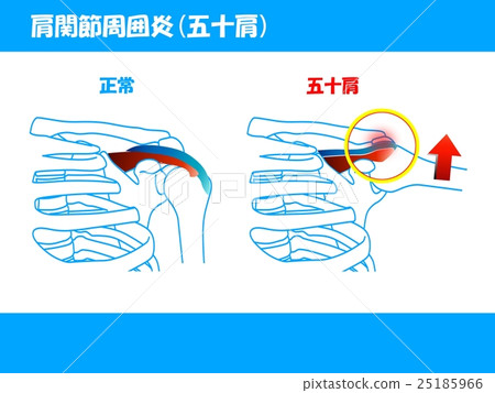 肩關節炎症(肩周炎) 肩關節炎症(肩周炎) 25185966