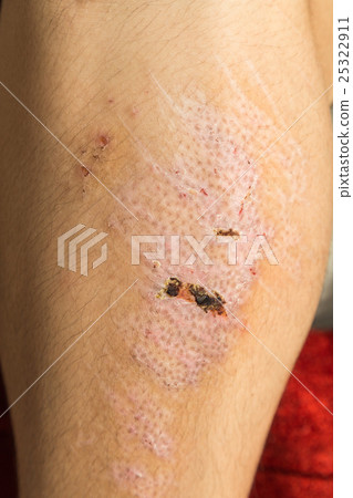 Injured knee with scar from abrasion healing 25322911