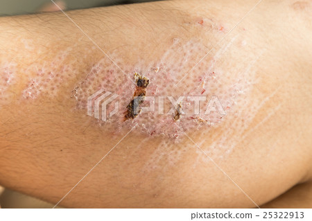 Closeup on injured knee with scar healing 25322913