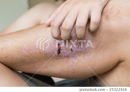 Finger scratching itchy knee with healing injury 25322916
