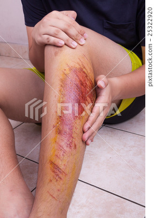 Hand embracing injured knee with painful abrasion 25322920