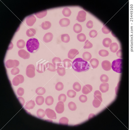 blast cells in peripheral blood images. blast cells in peripheral blood images. 25449160