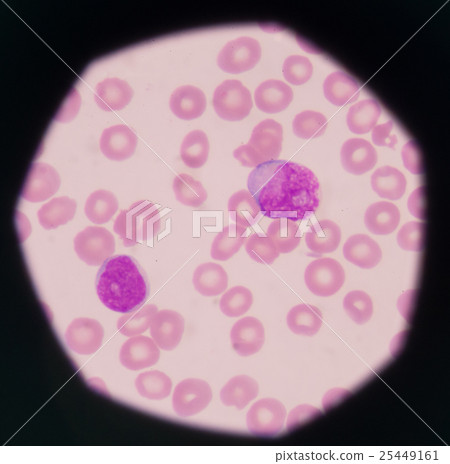 blast cells in peripheral blood images. blast cells in peripheral blood images. 25449161