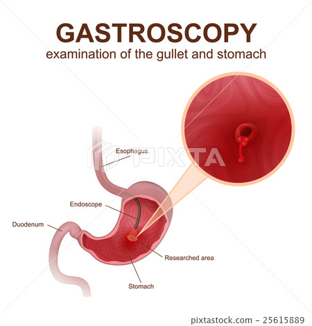 gastroscopy procedure EGD gastroscopy procedure EGD 25615889