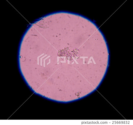 calcium oxalate crystal in urine analysis. calcium oxalate crystal in urine analysis. 25669832