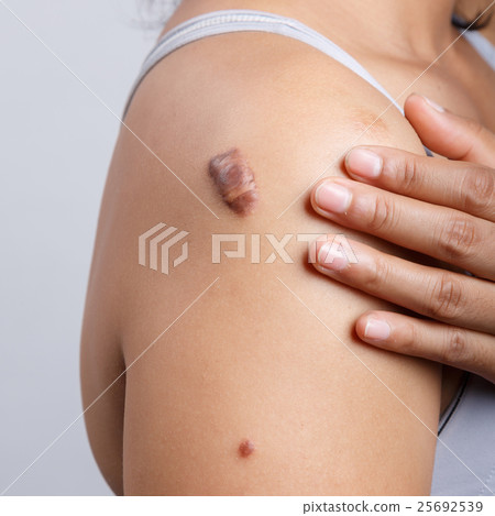 Scar on human skin Scar on human skin 25692539