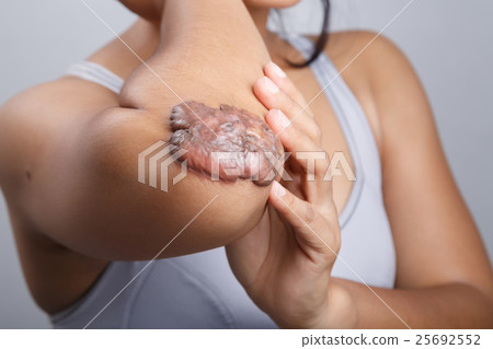 Scar on human skin Scar on human skin 25692552