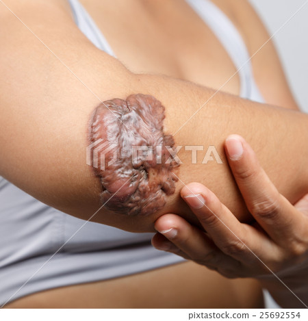 Scar on human skin 25692554