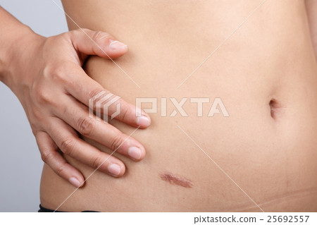 Scar on human skin Scar on human skin 25692557