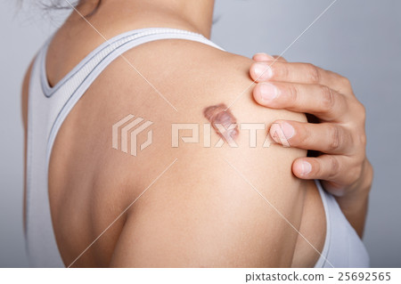 Scar on human skin Scar on human skin 25692565