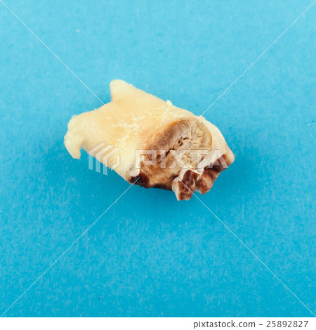 Single highly decayed wisdom tooth Single highly decayed wisdom tooth 25892827