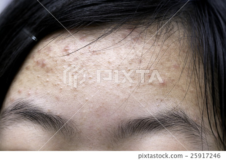 Acne 25917246