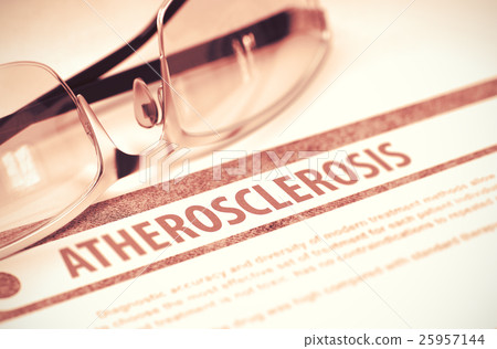 Atherosclerosis. Medicine. 3D Illustration. Atherosclerosis. Medicine. 3D Illustration. 25957144