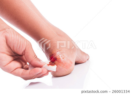 wound at heel wound at heel 26001334