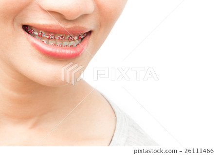 Close up woman smiling with Ceramic Metal Braces 26111466