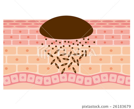 Moles cross section medical care - Stock Illustration [26183679] - PIXTA
