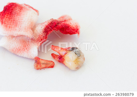 Extraction of decayed tooth with bloody gauze Extraction of decayed tooth with bloody gauze 26398079