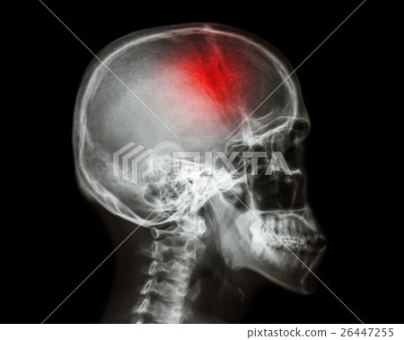 Stroke . 26447255