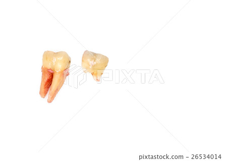 broken tooth removal with dental caries on white 26534014
