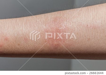 Dog bite wound and scar with dark background Dog bite wound and scar with dark background 26661644