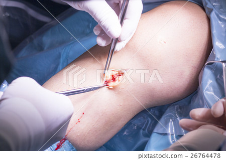 Surgical operation knee surgery Surgical operation knee surgery 26764478