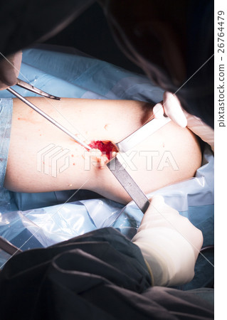 Surgical operation knee surgery Surgical operation knee surgery 26764479