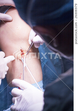 Surgical operation knee surgery Surgical operation knee surgery 26806979