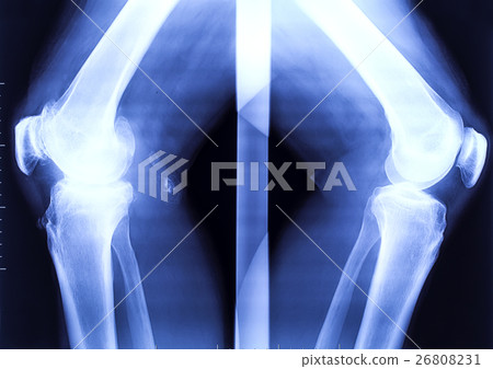 X-ray of the two bended knees X-ray of the two bended knees 26808231