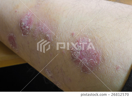 Psoriasis 26812570