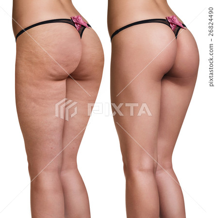 Female buttocks before and after cellulite Female buttocks before and after cellulite 26824490