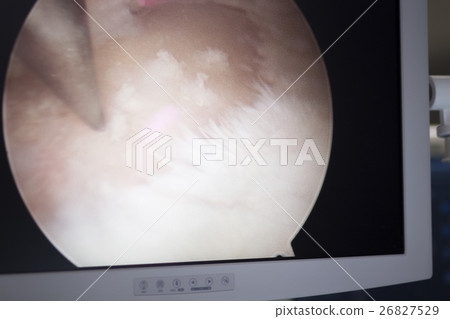 Arthroscopy surgery screen Arthroscopy surgery screen 26827529