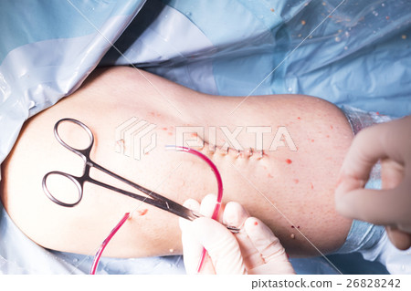 Surgical operation knee surgery Surgical operation knee surgery 26828242