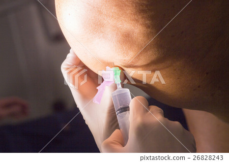 Anaesthetic injection in surgery Anaesthetic injection in surgery 26828243