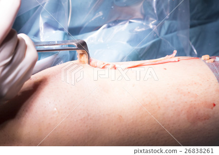 Surgical operation knee surgery Surgical operation knee surgery 26838261