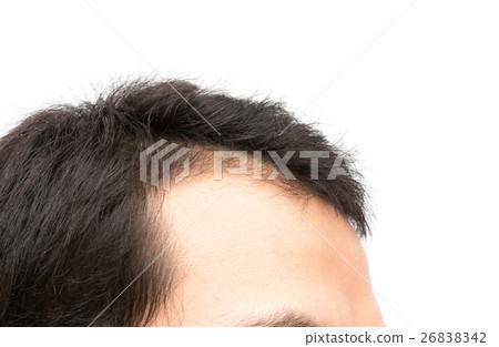 Young man serious hair loss problem Young man serious hair loss problem 26838342