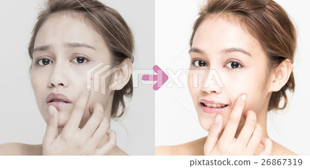 Acne Care Before After 26867319