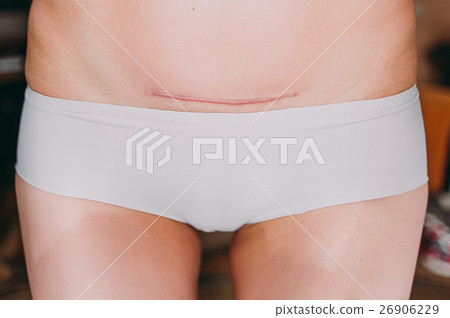Closeup of woman belly with a scar from Closeup of woman belly with a scar from 26906229