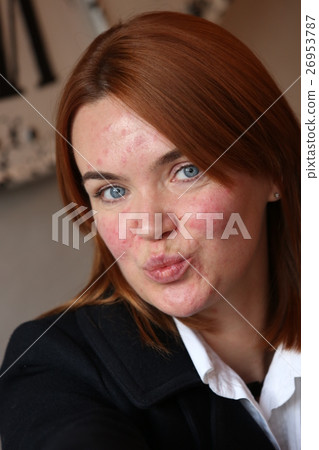 Red haired girl with acne 26953787