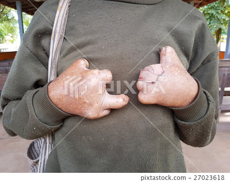 hands of asian old man suffering from leprosy hands of asian old man suffering from leprosy 27023618