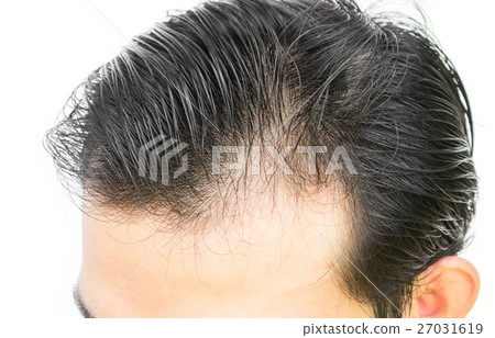 Young man serious hair loss problem 27031619