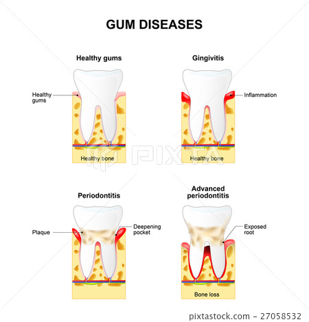 Gum disease 27058532