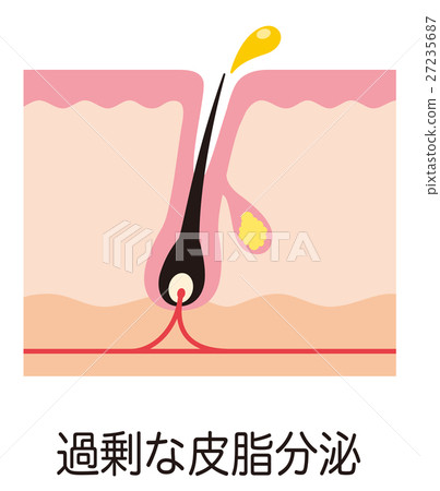 痤瘡的結構皮脂毛孔的結構 痤瘡的結構皮脂毛孔的結構 27235687