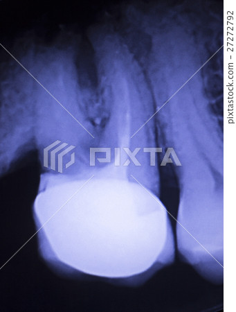 Tooth filling dental xray 27272792