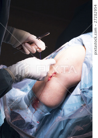 Surgical operation knee surgery 27282954