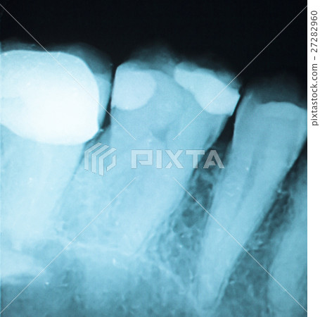 Tooth filling dental xray 27282960